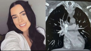 Fue al médico a retirarse implante anticonceptivo y descubrió que se movió hasta su corazón: 'Quedé sin palabras'