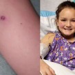 Revisa el caso de una pequeña niña que sufrió de una grave reacción a la picadura de una araña de rincón. La familia de la pequeña de 9 años en un comienzo pensó que era una reacción alérgica a la etiqueta de su ropa.