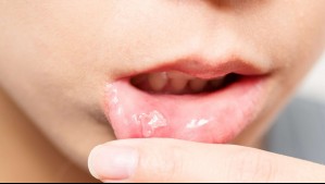 Aftas en la boca: Estas son las razones por las que aparecen y cómo puedes prevenirlas