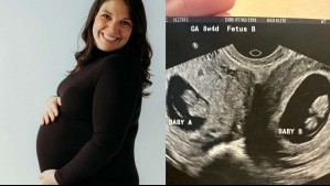 'Muy, muy raro': El caso de una mujer que nació con dos úteros y ahora tiene un embarazo doble