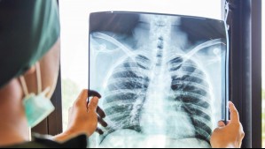 Cáncer de pulmón: Estos son los síntomas que indican que tus pulmones pueden estar fallando