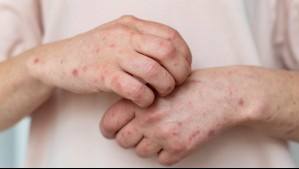 Dermatitis atópica: cómo reconocerla y qué cuidados hay que tener