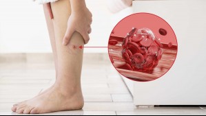 Atento a tus piernas: ¿Cuáles son los síntomas de una trombosis venosa profunda?