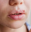 Revisa cuáles son las diferencias entre el herpes labial y el afta bucal.  Estos dos padecimientos son comúnmente confundidos, pero tienen causas y tratamientos distintos.