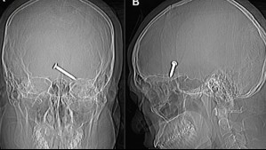 Hombre sobrevivió después de dispararse accidentalmente con una pistola de clavos en el cerebro