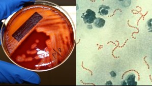 Streptococcus pyogenes: Lo que debes saber de la bacteria que provocó la muerte de niño en Chillán