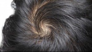 Investigadores chilenos ganan un premio 'antinobel' por estudio sobre los remolinos del pelo