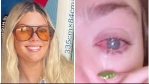 'El peor dolor que he experimentado': Joven quedó ciega de un ojo tras nadar con lentes de contacto en la playa