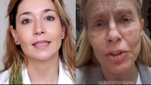 Cecilia Bolocco fuera de la Teletón por lesiones en el rostro: Experta explica por qué aparecen manchas en la piel