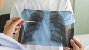 Alerta por alza de casos de neumonía por mycoplasma: ¿Cuáles son los síntomas de esta bacteria?