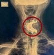 Conoce lo que se sabe sobre el caso de un adulto mayor de 81 años que se tragó accidentalmente su dentadura postiza luego de haber sufrido un episodio epiléptico en Perú.