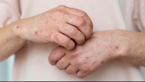 Alarmante aumento de casos de sarampión en Argentina y varios países del mundo: ¿Qué pasa en Chile?