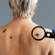 Un doctor especialista en dermatología reveló seis señales claves que sirven para detectar tempranamente el cáncer a la piel. Revisa cuáles son y cómo descubrirlas.