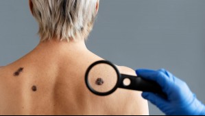 Estas son las 6 señales tempranas de cáncer de piel que todos deberían conocer