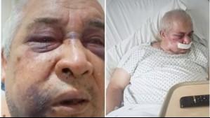 Podría perder su ojo: Denuncian brutal golpiza contra conserje de 70 años en Vitacura