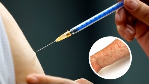 Minsal refuerza campaña de vacunación contra el sarampión para nacidos entre 1971 y 1981
