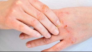 ¿Sufres de sabañones por el frío? Conoce cómo prevenir esta dolorosa afección