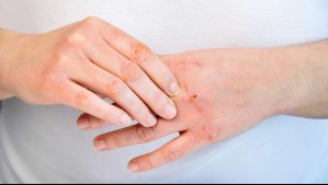 ¿Piel reseca en invierno? Conoce las causas más comunes y cómo prevenirla