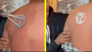 ¿Qué es el 'freeze branding'? Médicos advierten sobre la alternativa de moda al tatuaje