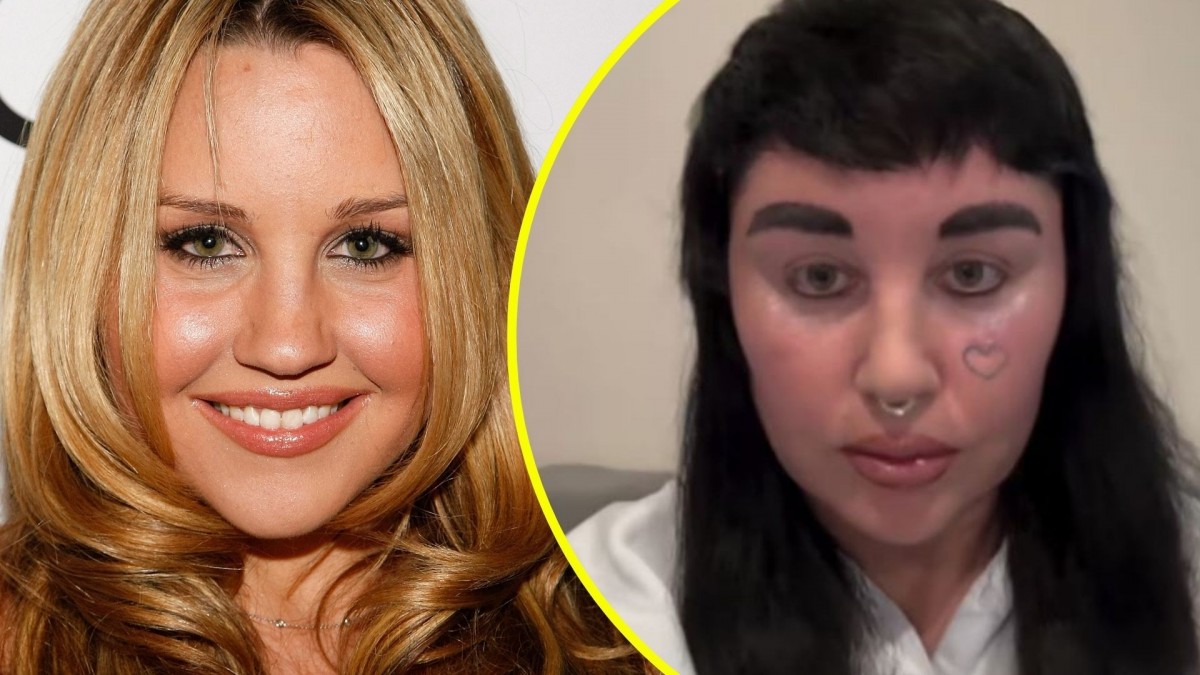 Exex Yunile Strella Amanda Bynesは、美的治療を受けた後に新たな外観で驚きました