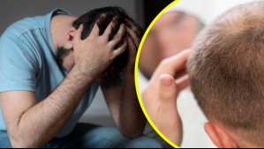 ISP advierte sobre fármaco para la calvicie: Podría causar depresión e ideación suicida