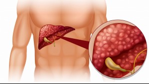 Hígado Graso: Investigadores de la Clínica Mayo logran confirmar el devastador efecto del alcohol en esta condición