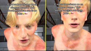 'No es ninguna broma': Influencer finlandés muestra cómo quedó tras quemarse con el sol en Chile