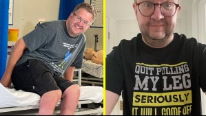 Fue condenado por estafa: Descubren que cirujano se amputó las piernas a sí mismo por un 'fetiche sexual' y cobró millonaria suma