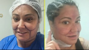 'Voy a quedar bonita': Denisse Campos mostró a través de redes sociales que se sometió a varios procedimientos estéticos