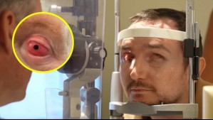 Le implantaron su propio diente en el ojo: Hombre ciego recuperó la visión gracias a una innovadora cirugía