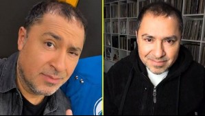 Chico Pérez se sometió a procedimiento estético: Intervención duró casi 8 horas