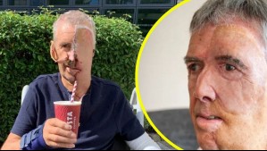 Hombre recibe 'cara impresa en 3D' en Reino Unido: Había sido atropellado por conductor ebrio y quedó desfigurado