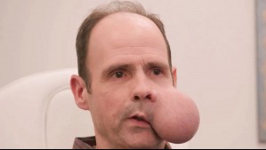 Hombre vive con tumor de casi 2 kilos en su cara: 'Puede ser una sentencia de muerte'