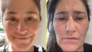 Pensó que 'iba a morir del dolor': Estos son los síntomas de la neuralgia del trigémino, la afección que aqueja a Belén Mora