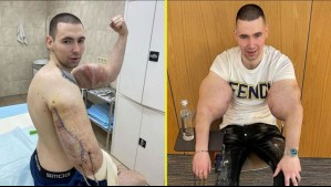 El 'Popeye ruso': Influencer se inyectó vaselina en los bíceps y ahora podría perder ambos brazos