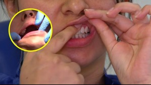 ¿Cómo detectar con un autoexamen un posible cáncer oral?: Advierten riesgos por diagnóstico tardío de la enfermedad