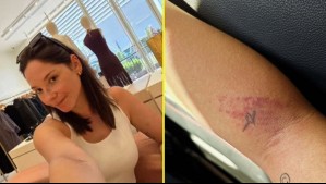 Kel Calderón sufrió accidente que le dejó moretones en la cara y brazo: Utilizó método casero para bajar hinchazón