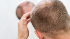 Revolucionario tratamiento contra la calvicie: ¿Qué es la clascoterona?