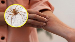 ¿Te mordió una araña de rincón?: Esto es lo que debes hacer