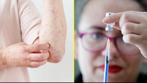 Minsal confirma caso de sarampión importado en la Región Metropolitana: Paciente no estaba vacunado