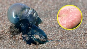 Es tóxica estando viva o muerta: ¿Cómo reconocer a una fragata portuguesa y qué hacer en el caso de una picadura?