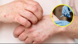 Caso de sarampión importado en Chile: ¿Qué personas deben vacunarse?