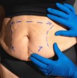 Revisa cuál es el monto que debe pagar un paciente que se quiere realizar un procedimiento de abdomen flácido o abdominoplastía con Bono PAD, beneficio exclusivo de Fonasa.