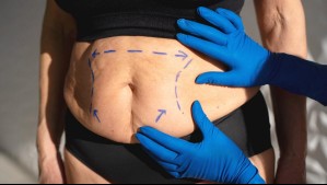 Bono Pad Abdomen Flácido: ¿Cuánto paga el usuario?