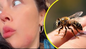 Daniela Aranguiz mostró su rostro tras picadura de abeja: Estas pueden ser las consecuencias