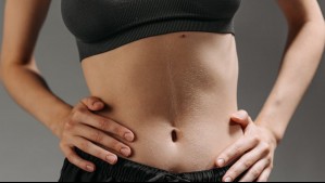 Bono Pad hernia abdominal: ¿Cuánto paga el usuario?