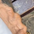 Un chileno se volvió viral tras revelar cómo una infección de muela derivó en daños al corazón, pérdida de riñones y cinco años de diálisis, dejando además secuelas visibles en su brazo.