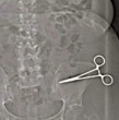 Los cirujanos olvidaron las tijeras médicas dentro del cuerpo de la paciente y estas le provocaron dolores insoportables durante siete largos meses, hasta que un escáner abdominal reveló la grave negligencia