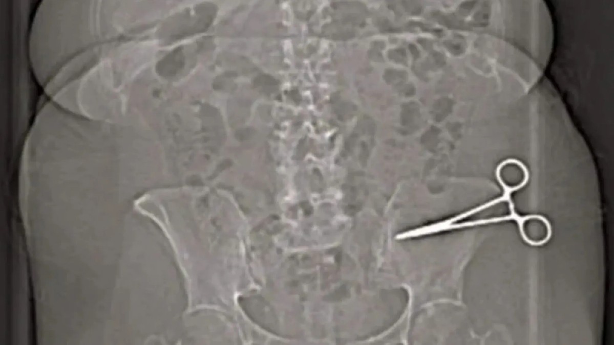 'Jamás volveré a poner un pie allí': mujer sobrevive siete meses con unas tijeras en el abdomen luego de una cirugía estética