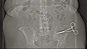 'Jamás volveré a poner un pie allí': mujer sobrevive siete meses con unas tijeras en el abdomen luego de una cirugía estética